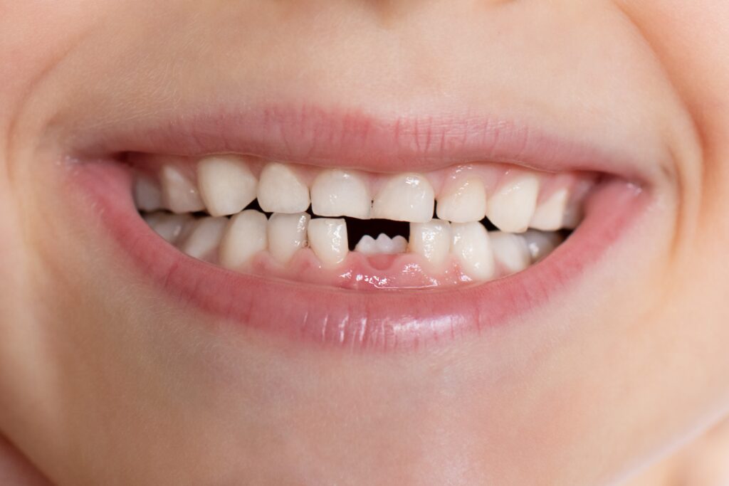 A child smiling and showing a missing baby tooth highlighting the importance of dental crown for kids in Highland