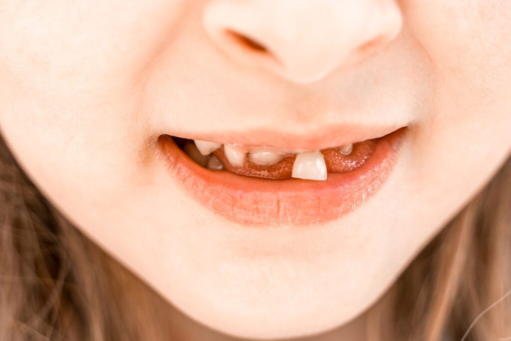 Ways to Safely Remove Your Child’s Loose Tooth.