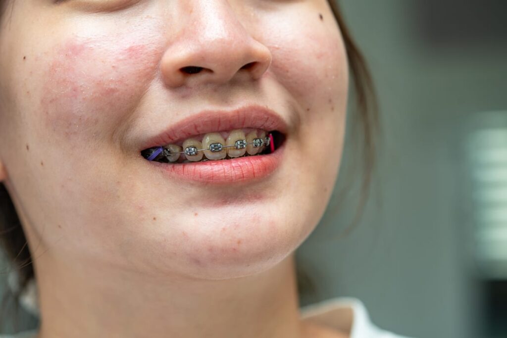 When does my child need braces in Highland